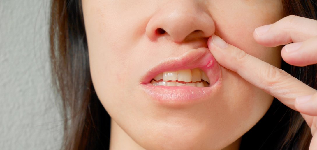 Afty w jamie ustnej  – czy są zaraźliwe? Jak wyglądają i kiedy znikają? Wylecz je domowymi sposobami