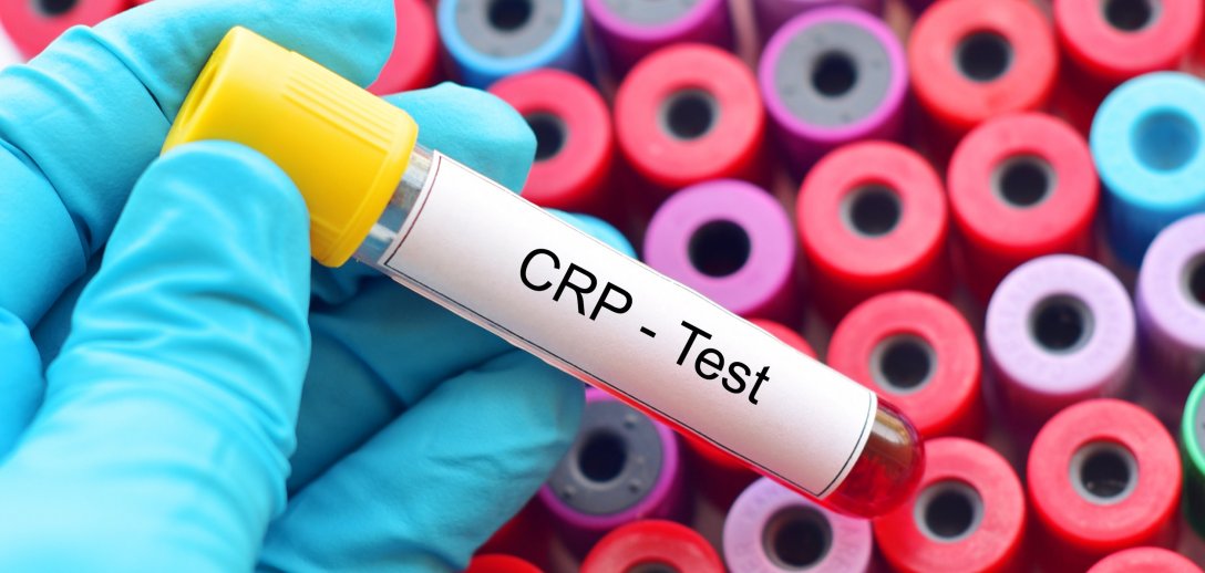 Badanie CRP – na czym polega diagnozowanie stanu zapalnego, jakie są normy, jak odczytać wynik