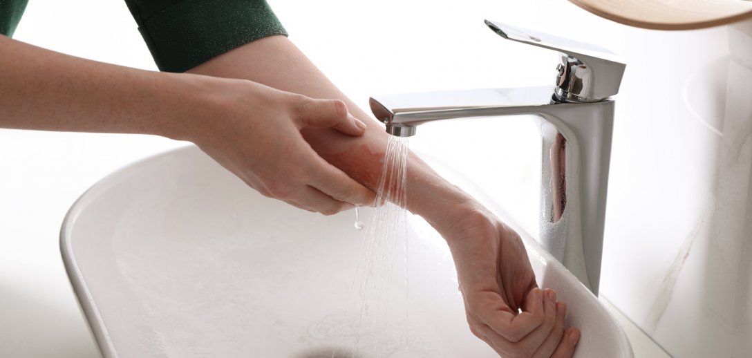 Domowe sposoby na oparzenie – co robić, by złagodzić ból i przyspieszyć gojenie skóry